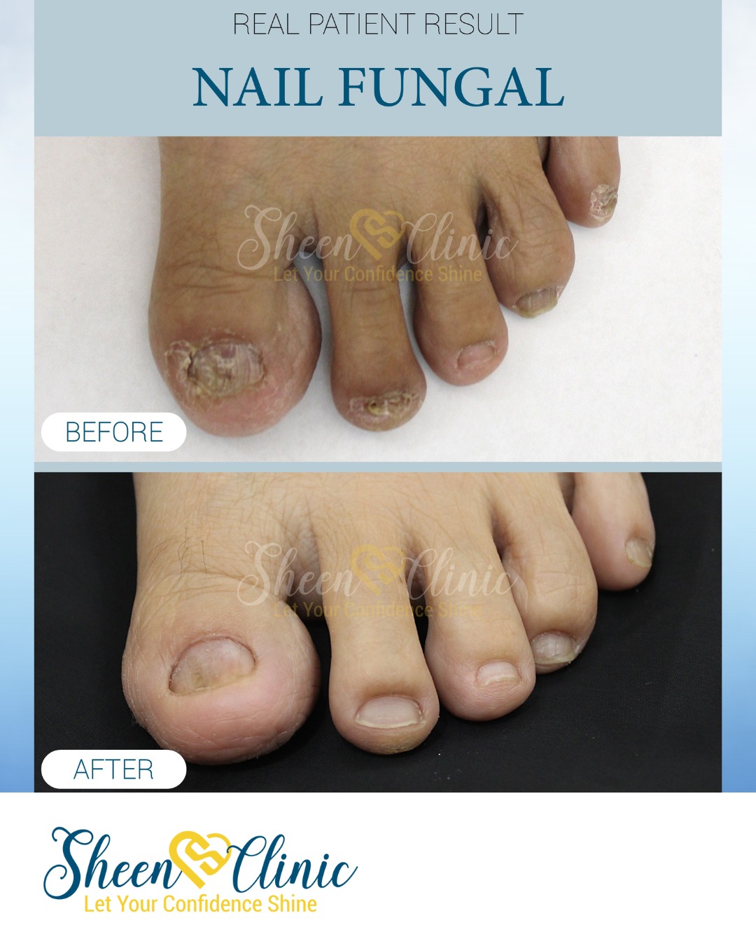Fungal Nail Treatment