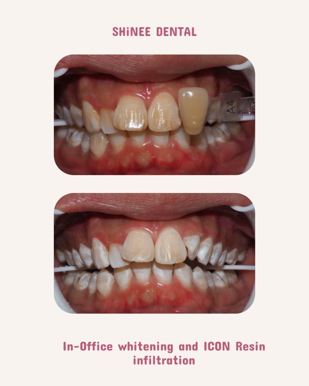 Teeth whitening results in JB