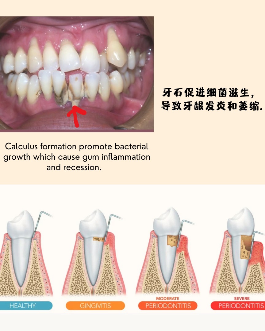 Does scaling hurt and cause bleeding? Gum bleeding doesn’t necessarily mean the cleaning was too rough