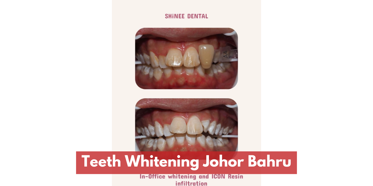 Teeth Whitening JB | Why More Patients Choose Gentle, Dentist-Led Whitening