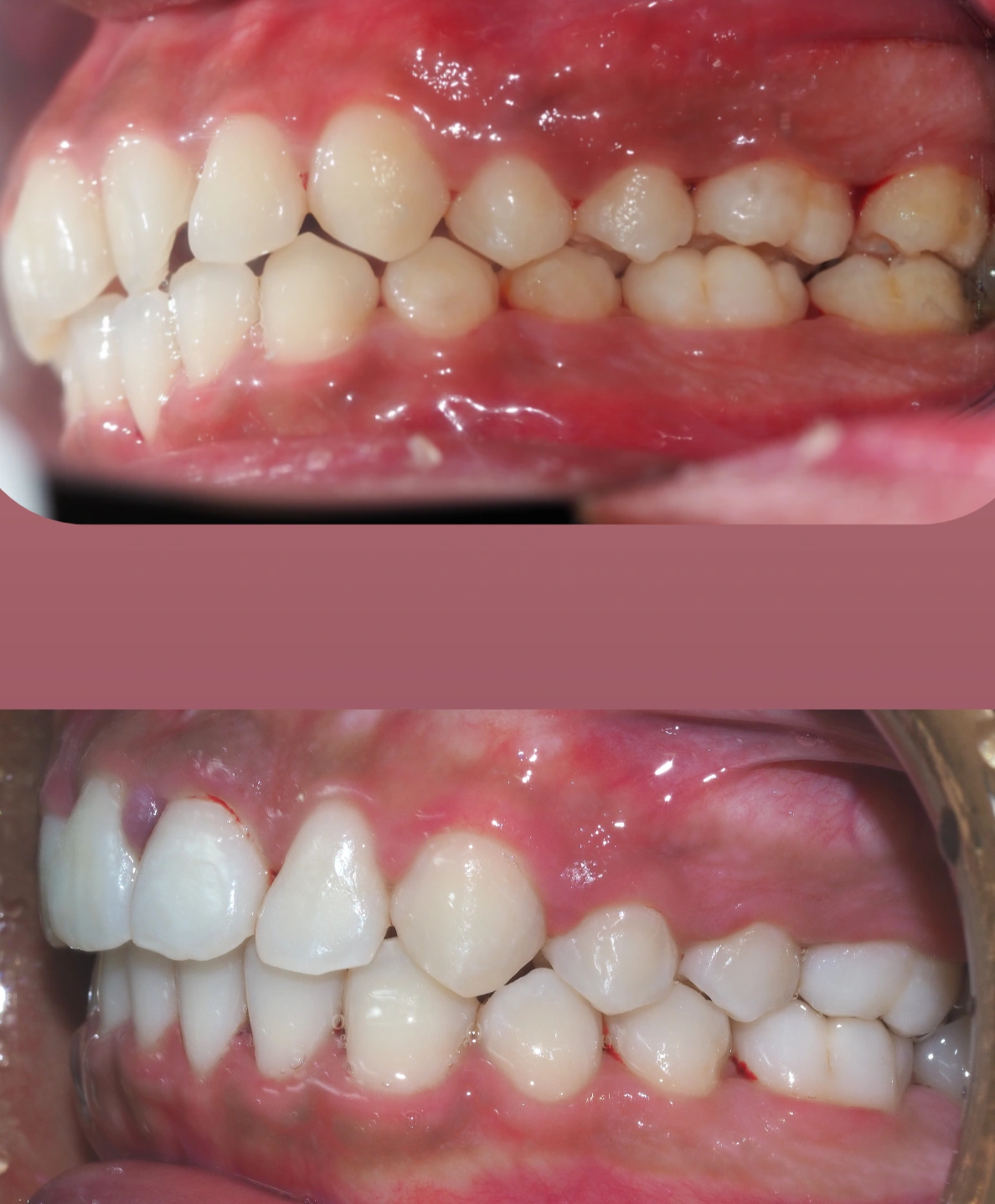 Braces in JB self-ligating braces before and after result case one