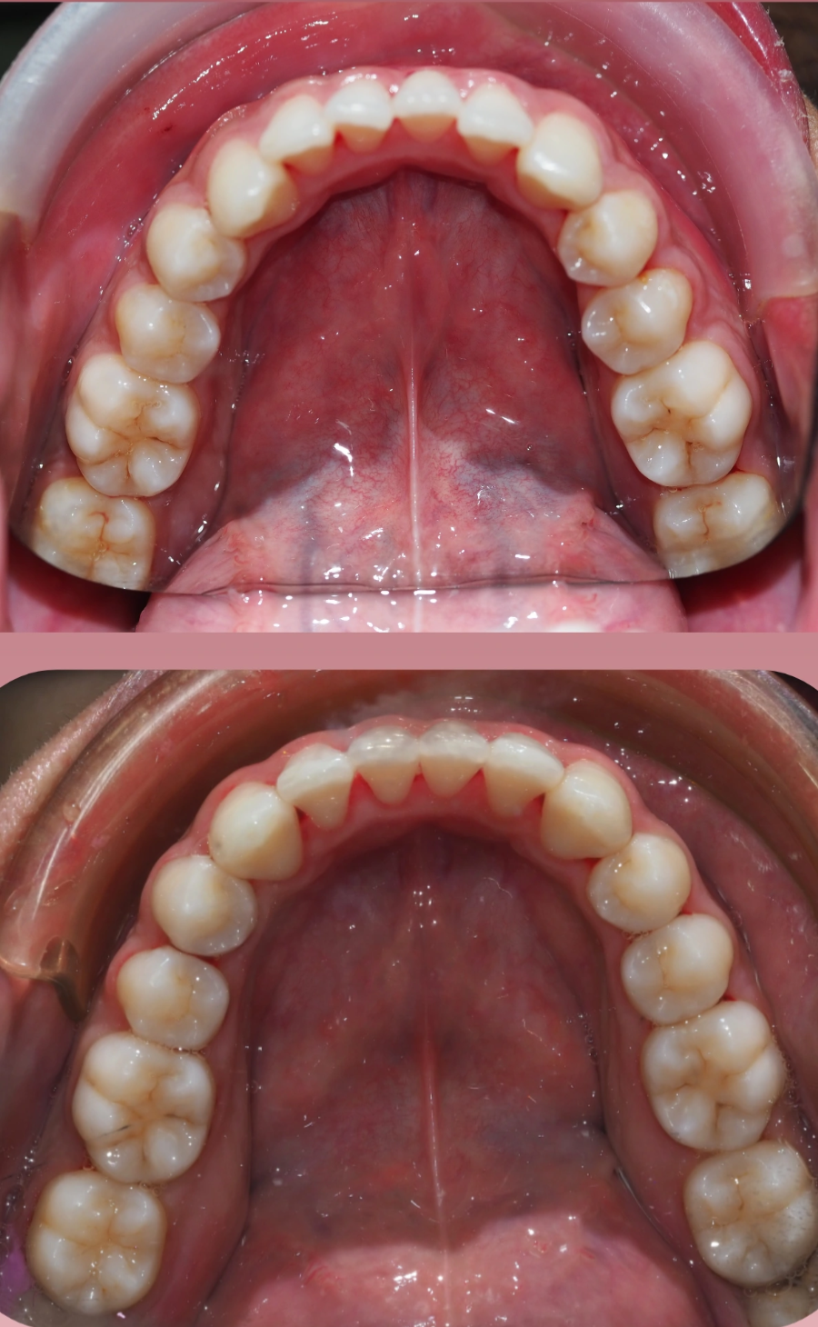 Self-ligating braces JB before and after orthodontic result case two