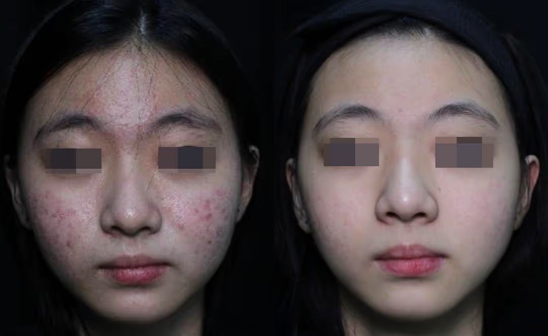 Real acne treatment result case at Aglow Clinic Malaysia