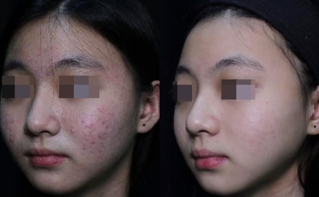 Real acne improvement case from doctor-led aesthetic treatment