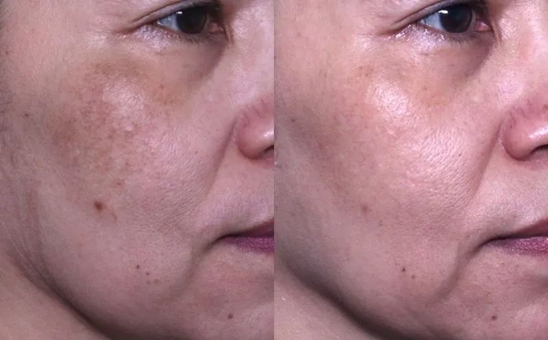 Real pigmentation and dark spot improvement result