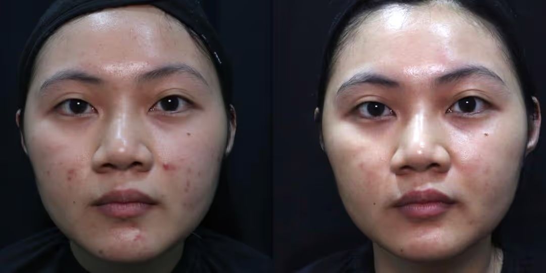 Real pigmentation treatment result case at Aglow Clinic Malaysia