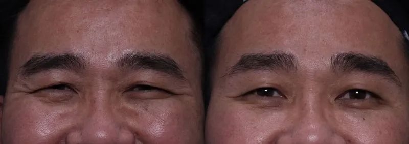 Real face contouring treatment result case at Aglow Clinic Malaysia