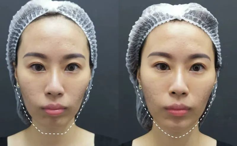 Real facial contouring and enhancement result