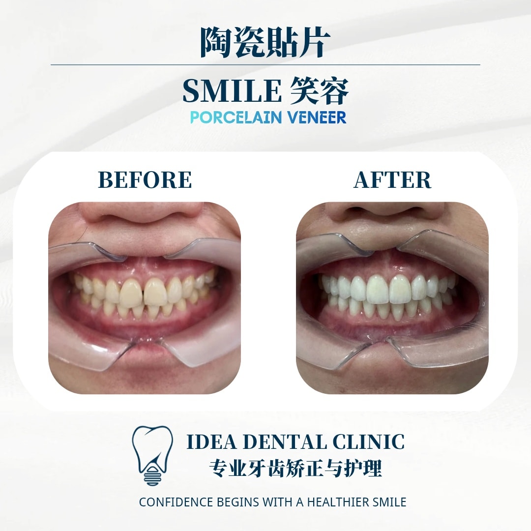Before & After Whitening