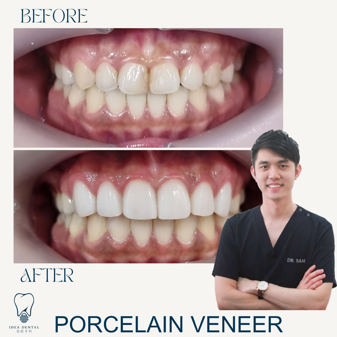 Teeth whitening before and after example