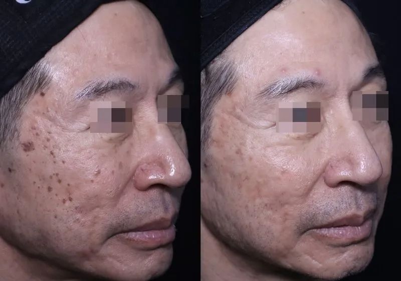 Pigmentation Laser Treatment In KL result example 1