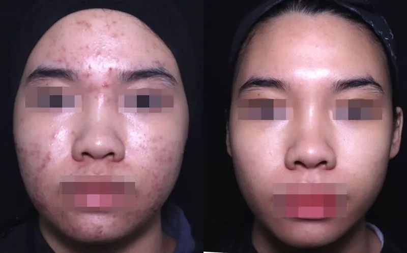 Pigmentation Laser Treatment In KL result example 2