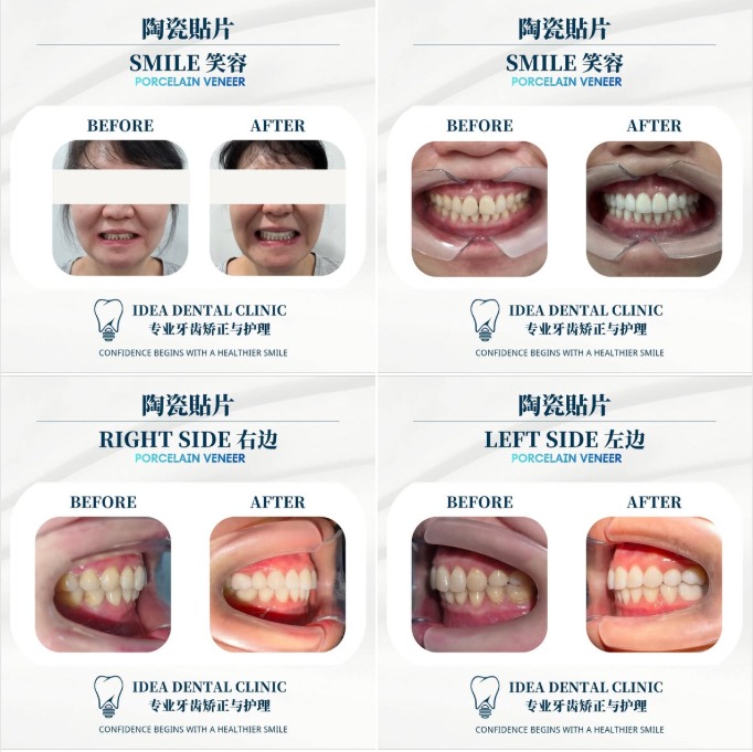 Porcelain veneers before and after JB results for cosmetic veneers Johor Bahru