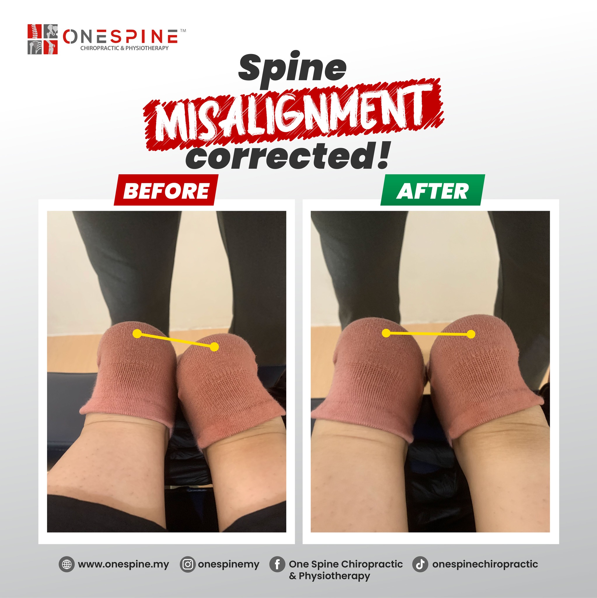 Posture and lower limb alignment assessment before rehabilitation